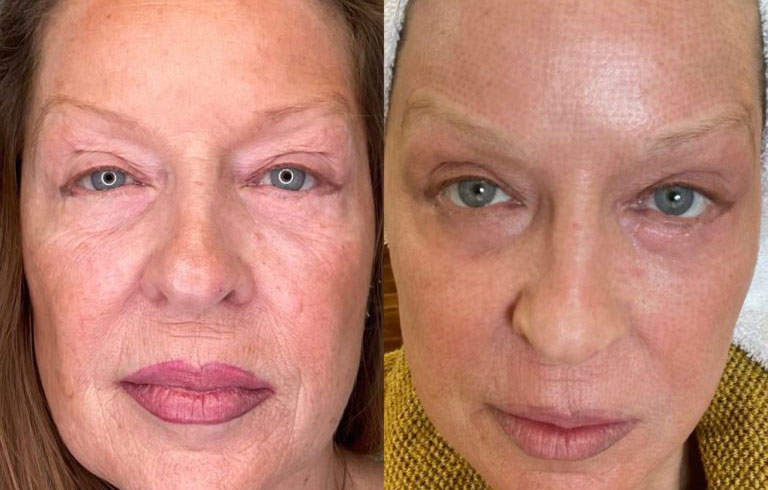 Before After