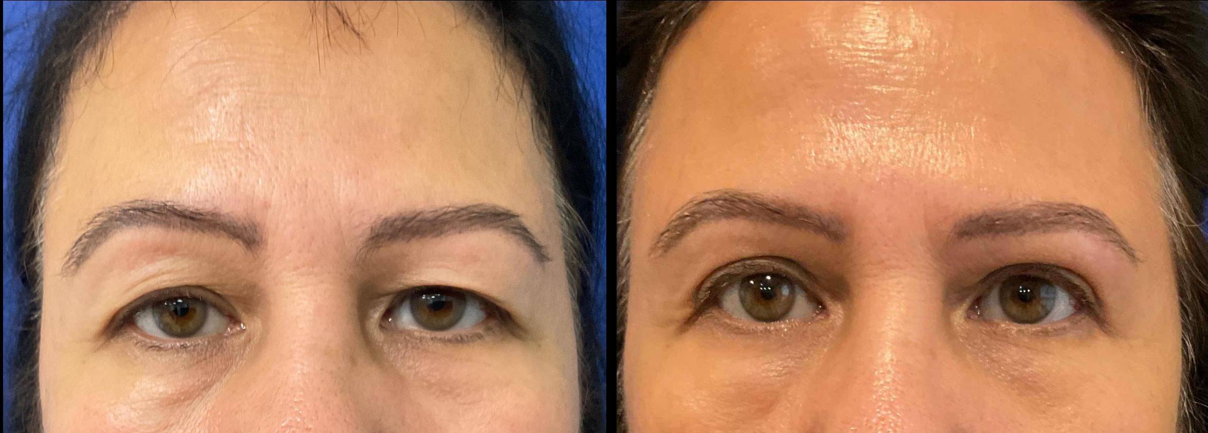 Blepharoplasty Case 6 