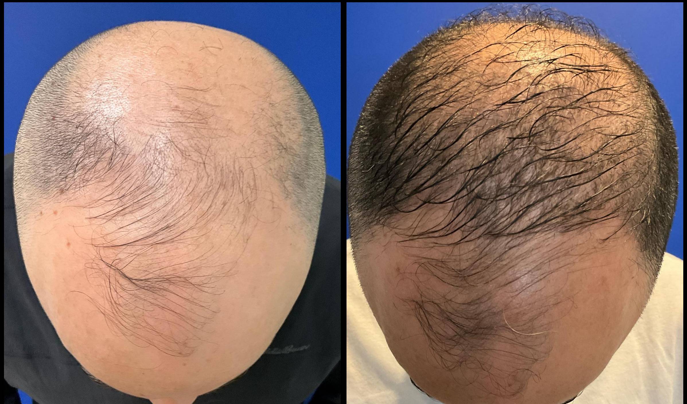 Hair Transplant 1 