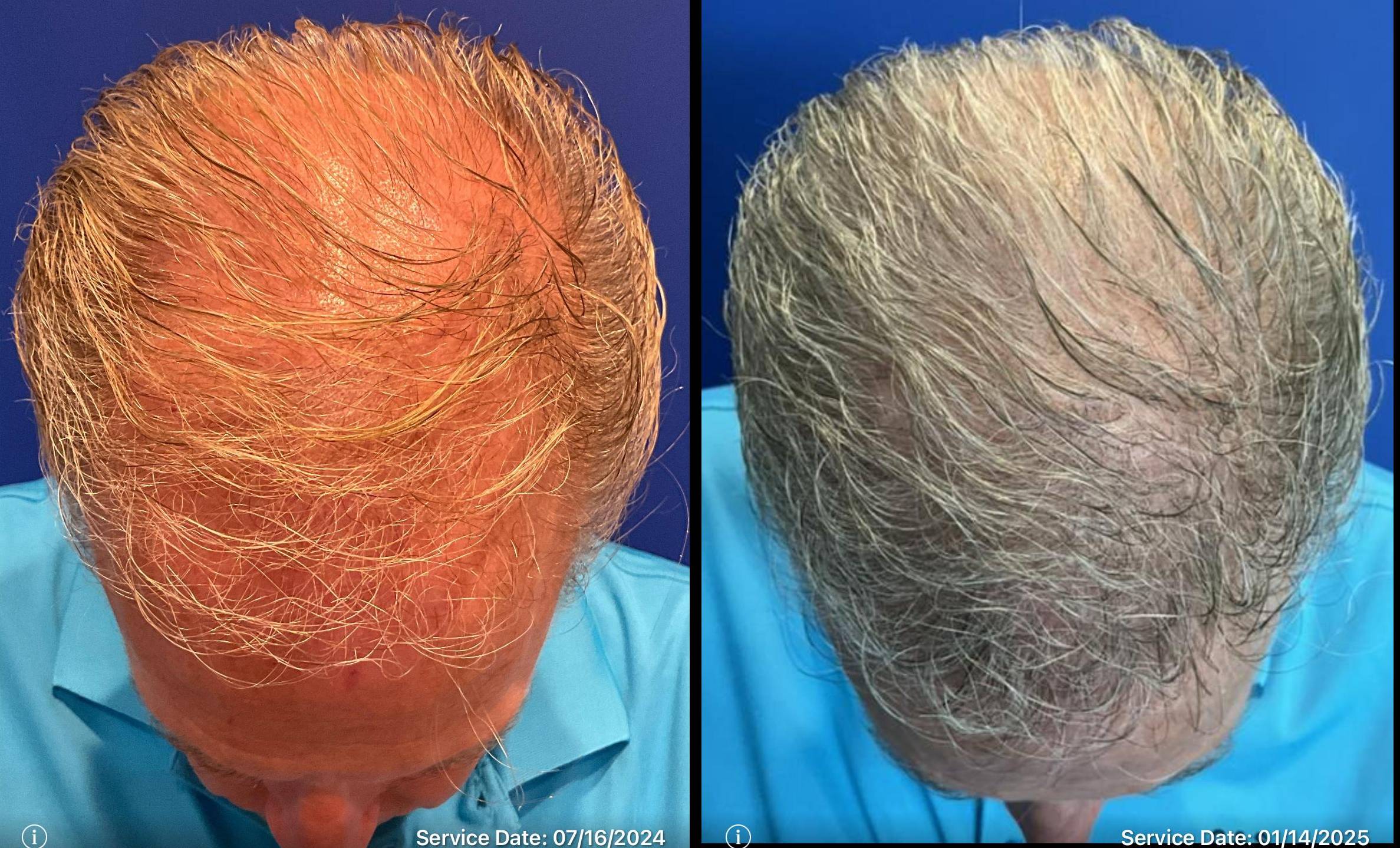 Hair Transplant 