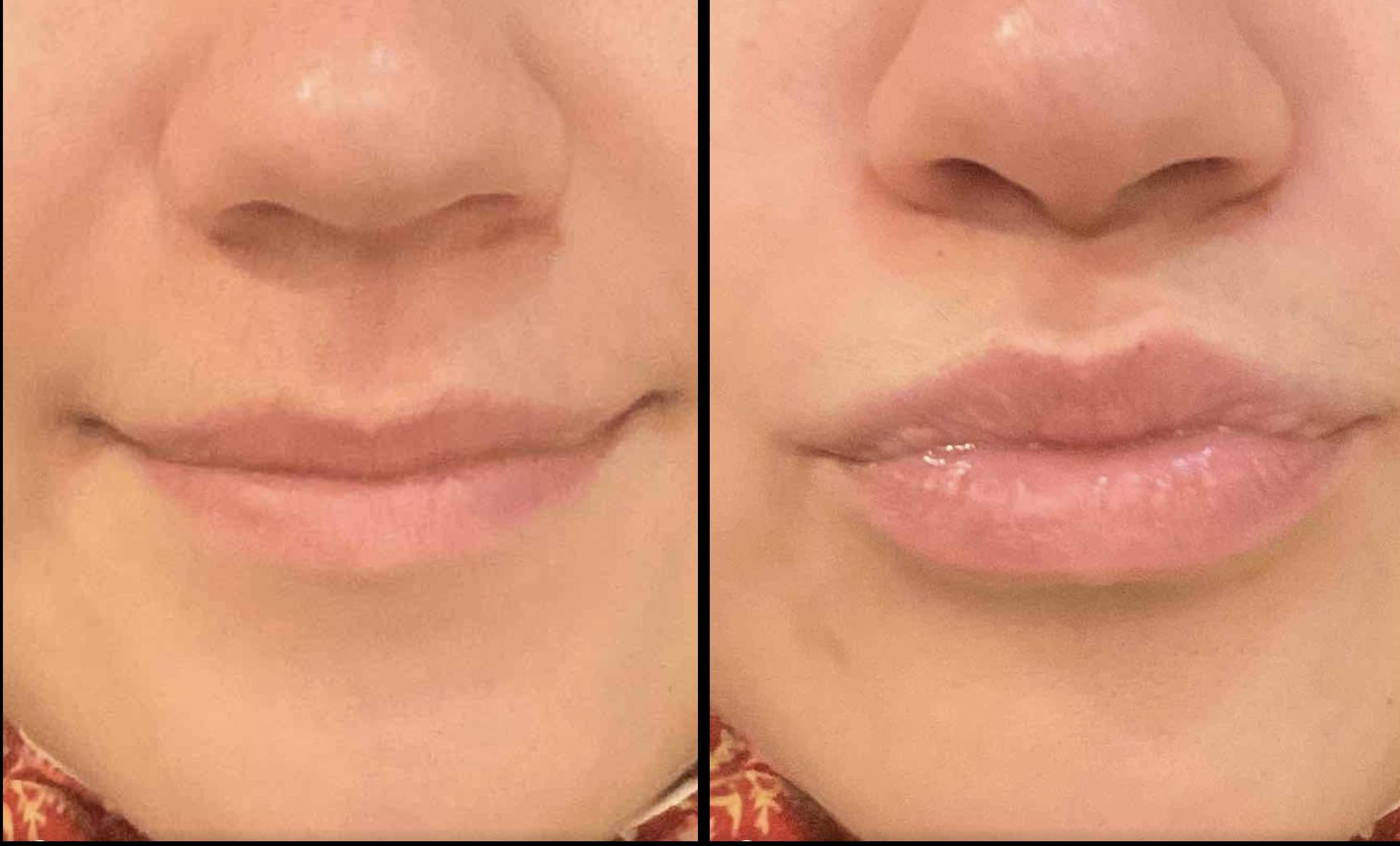 Lip Filler 