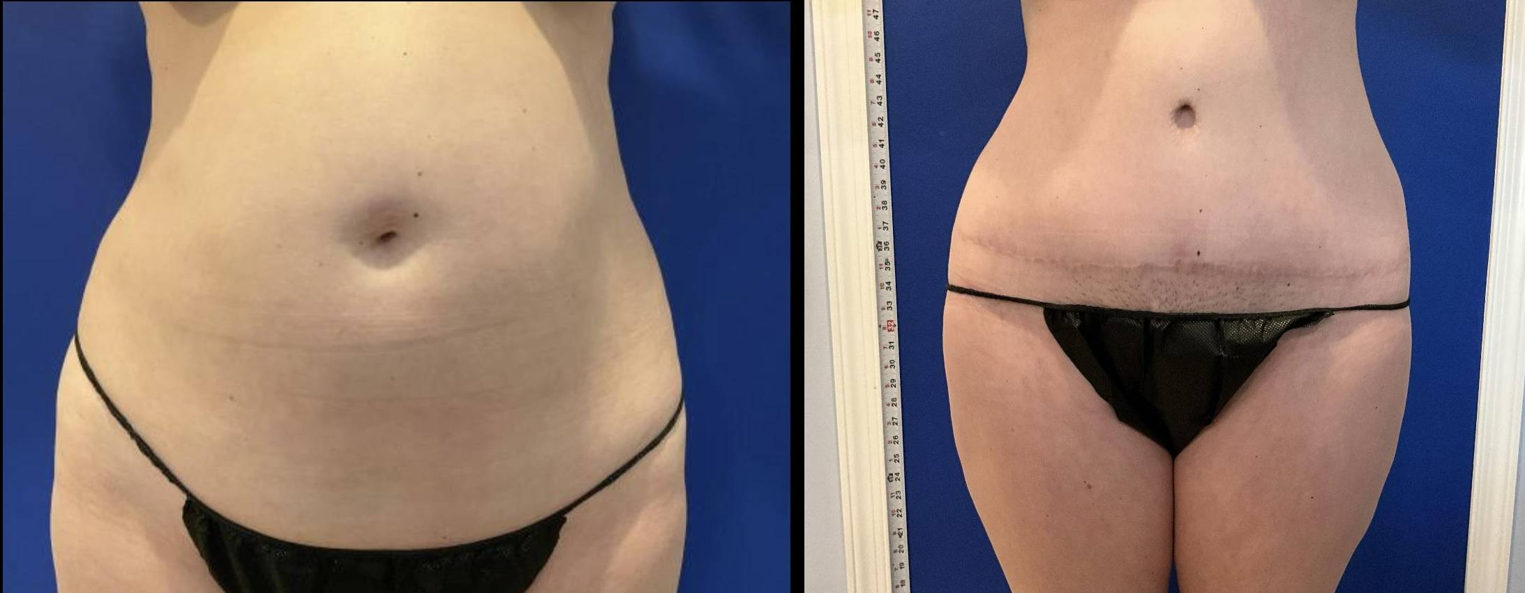 Tummy Tuck Case 9 