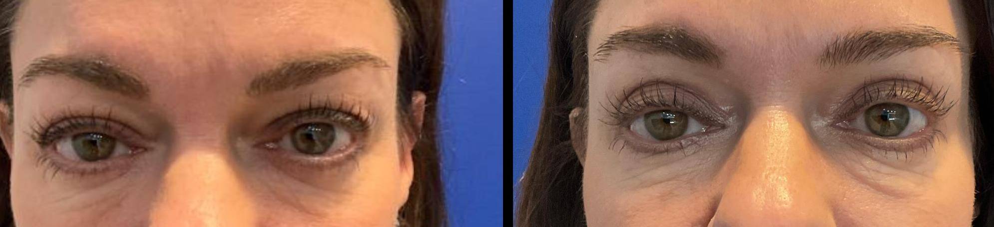Upper Lid Blepharoplasty Case 7 