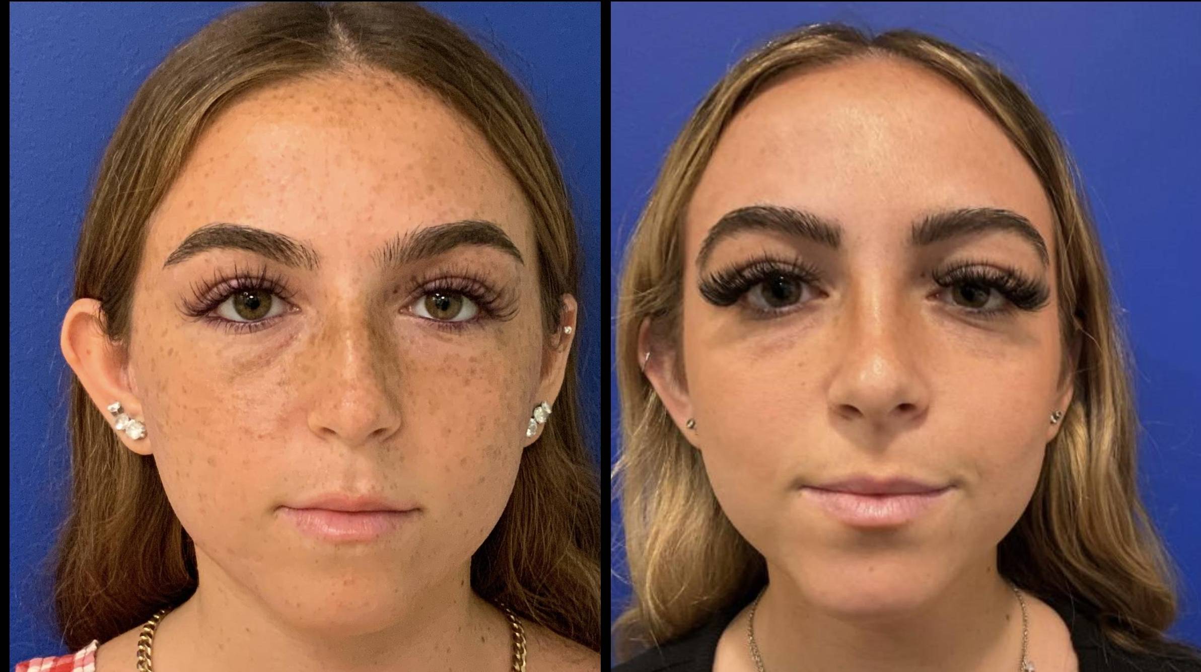 Rhinoplasty 