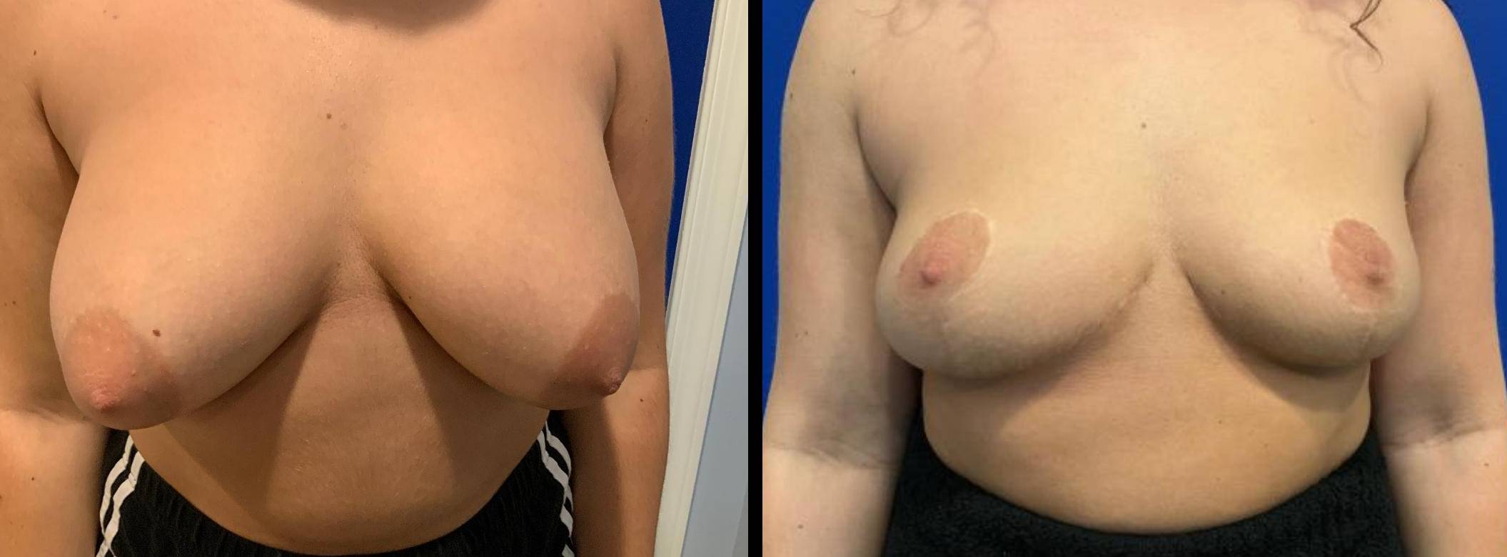 Breast Implant Removal with Lift 