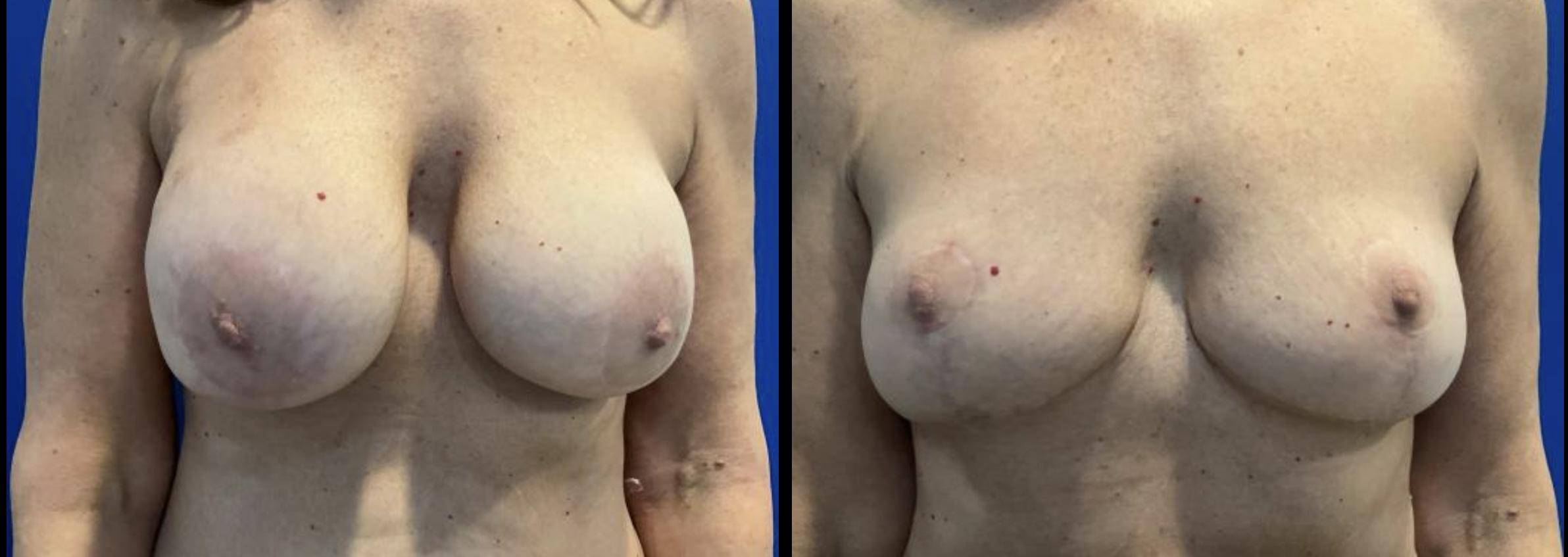 Breast Implant Removal with Mastopexy 3 