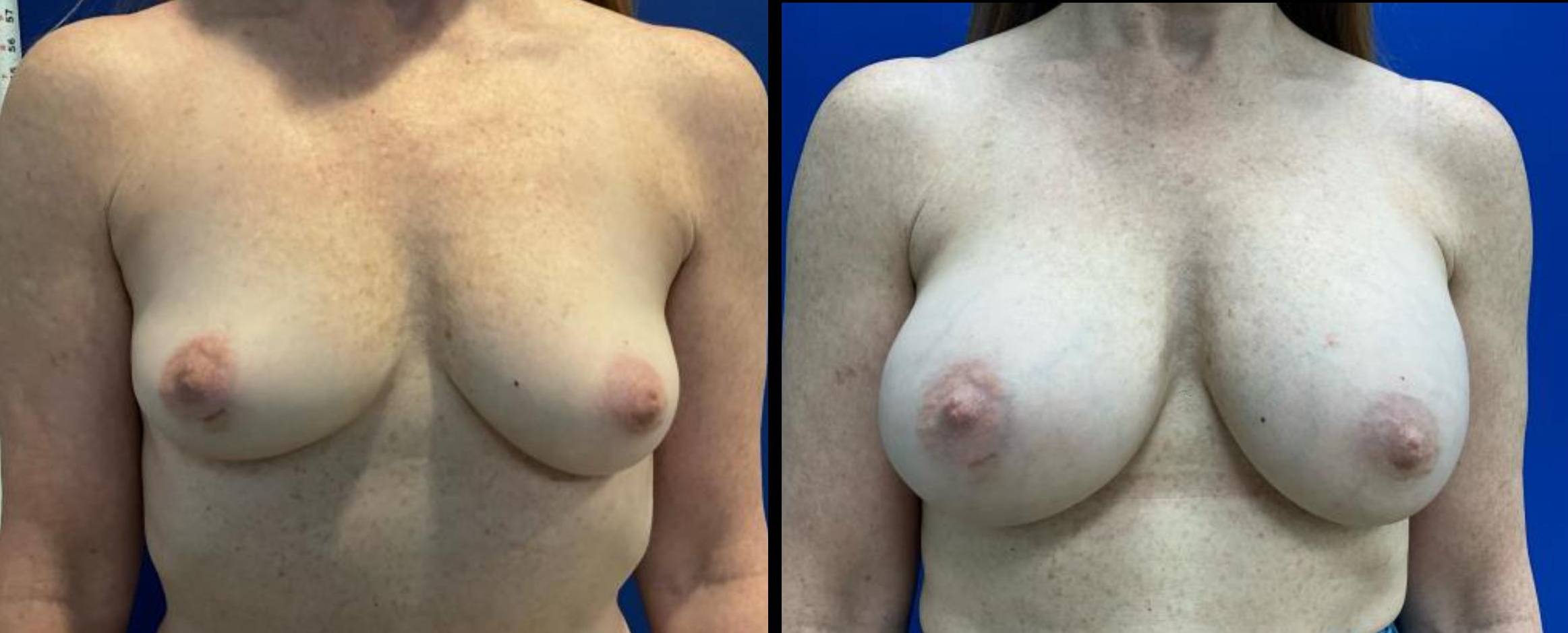 Breast Augmentation Case 14 