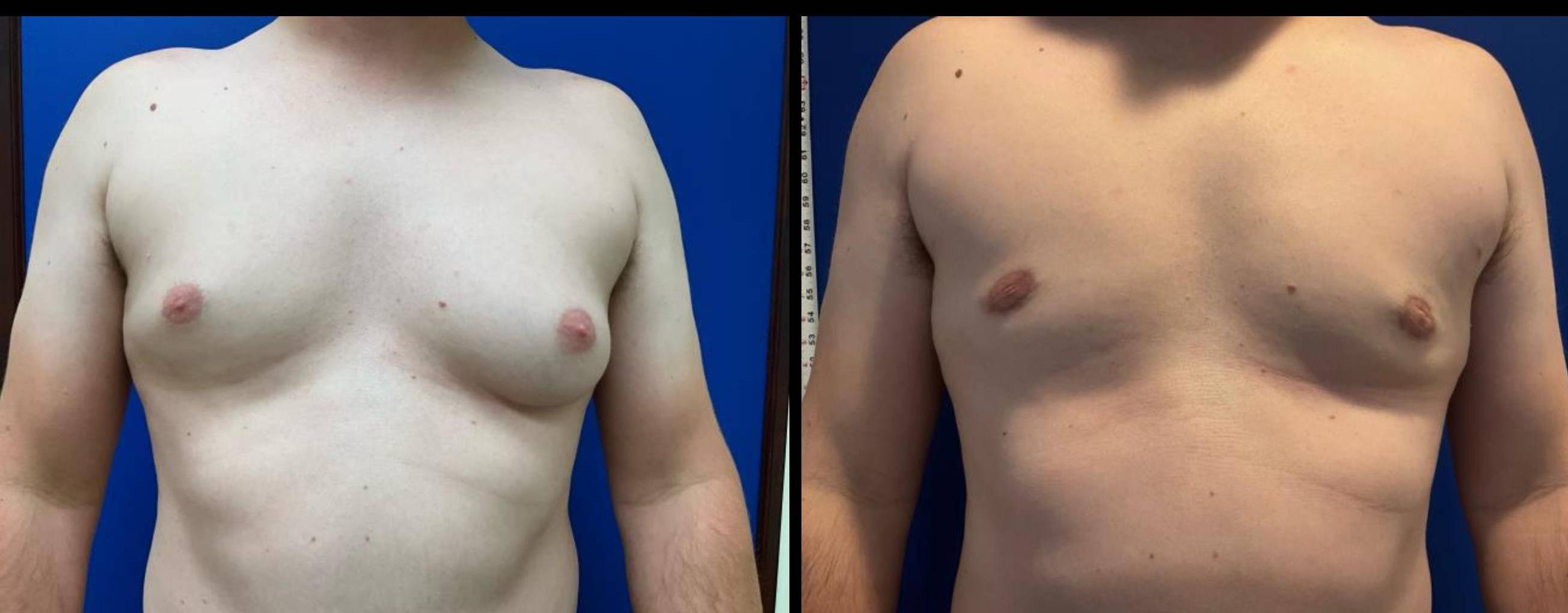 Gynecomastia Before