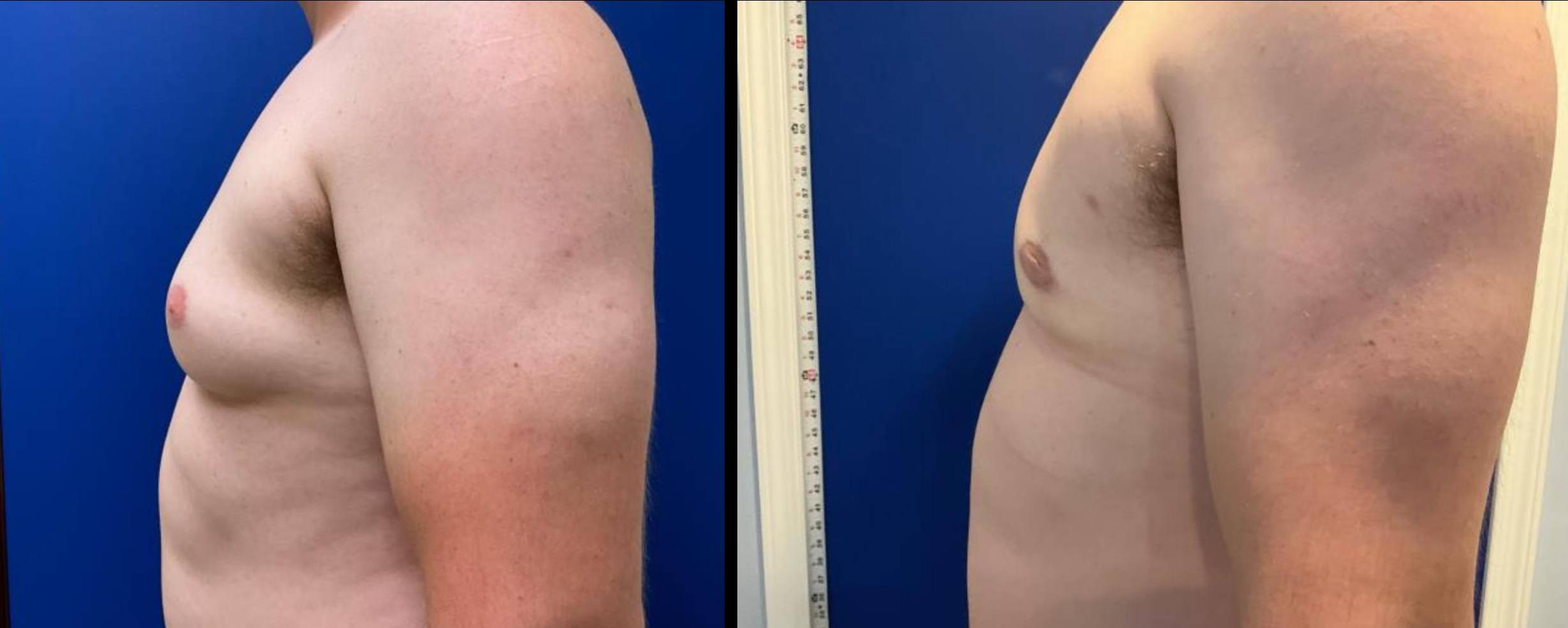 Gynecomastia After