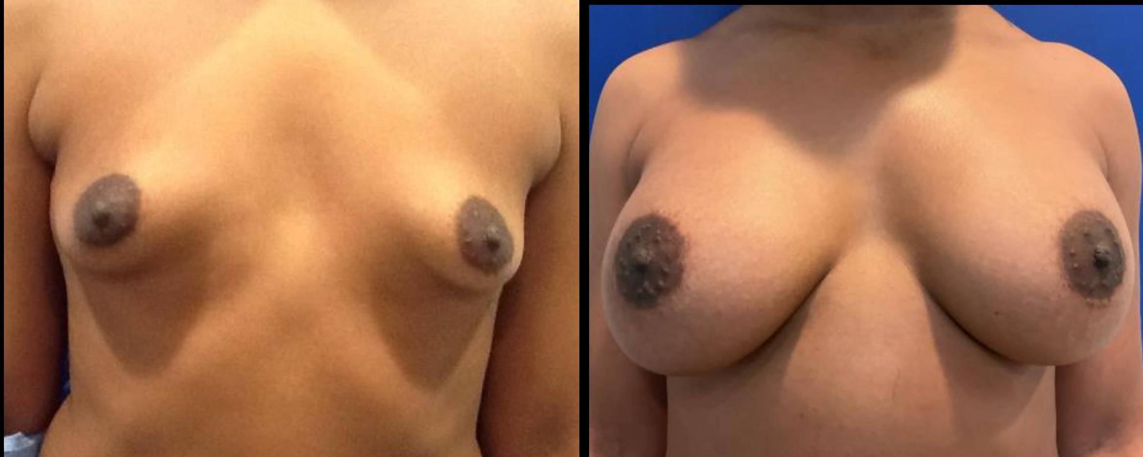 Breast Augmentation Case 15 