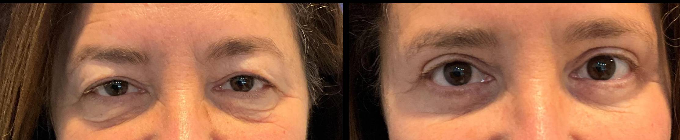 Blepharoplasty Case 8 
