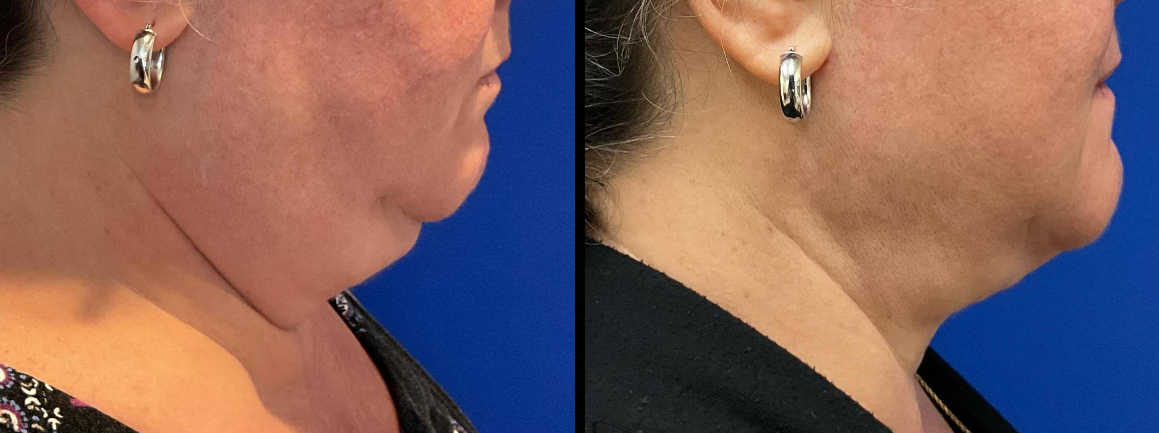 Liposuction Case 8 