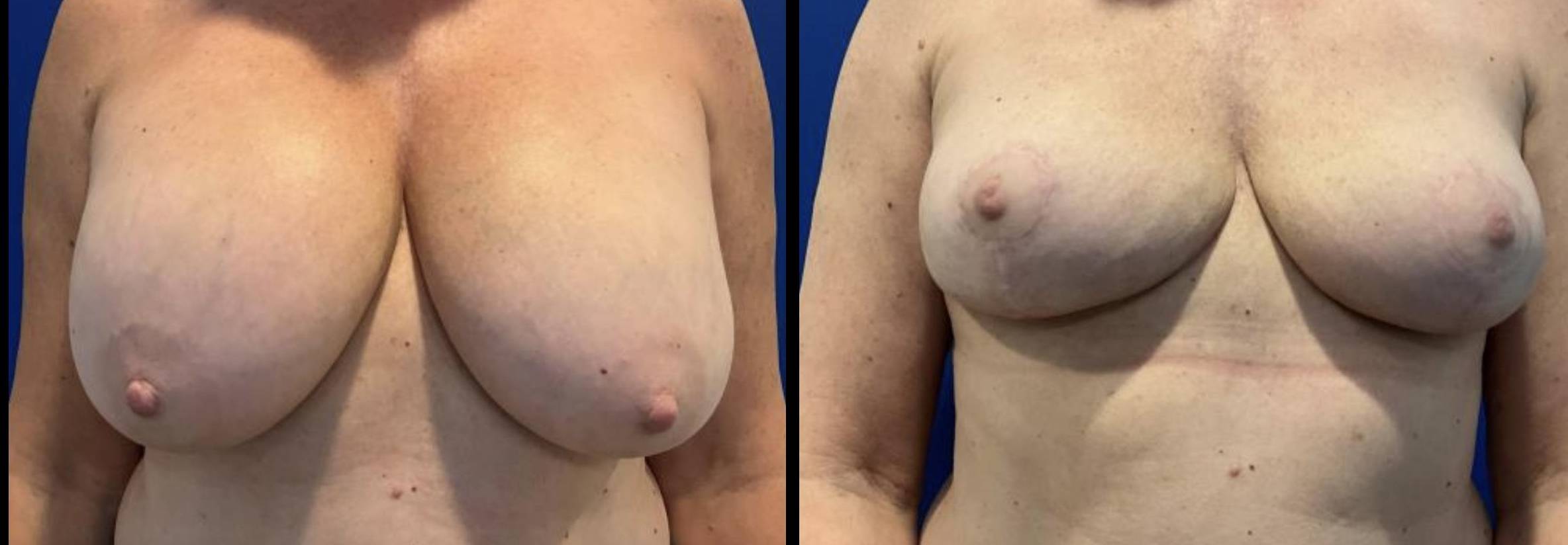 Breast Implant Removal with Mastopexy 4 