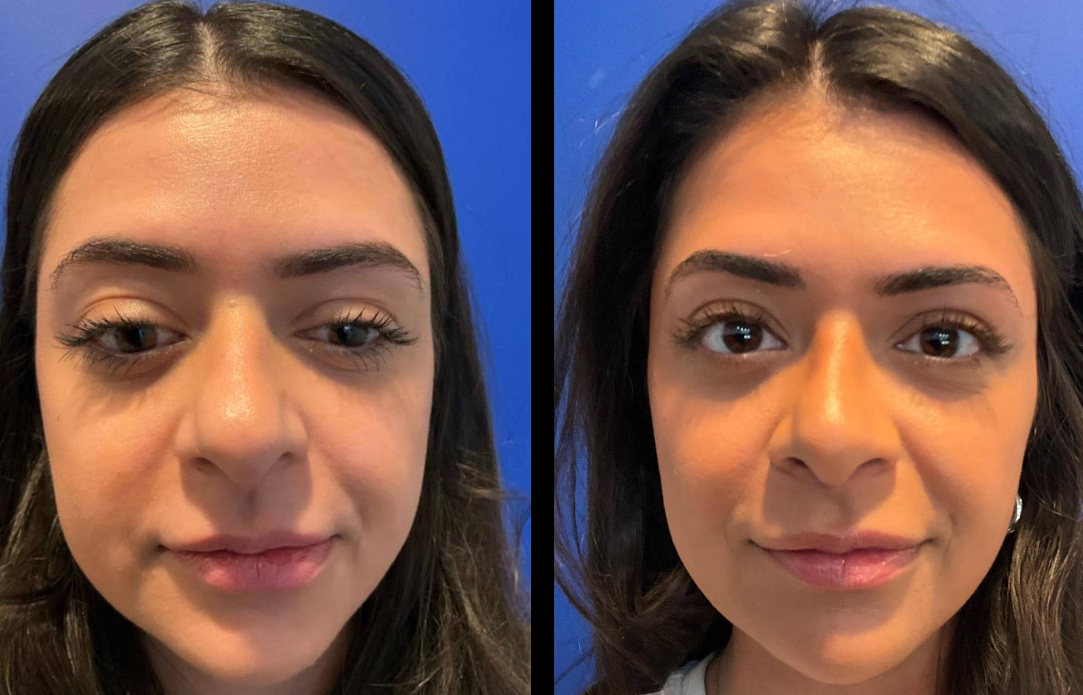 Rhinoplasty Case 7 
