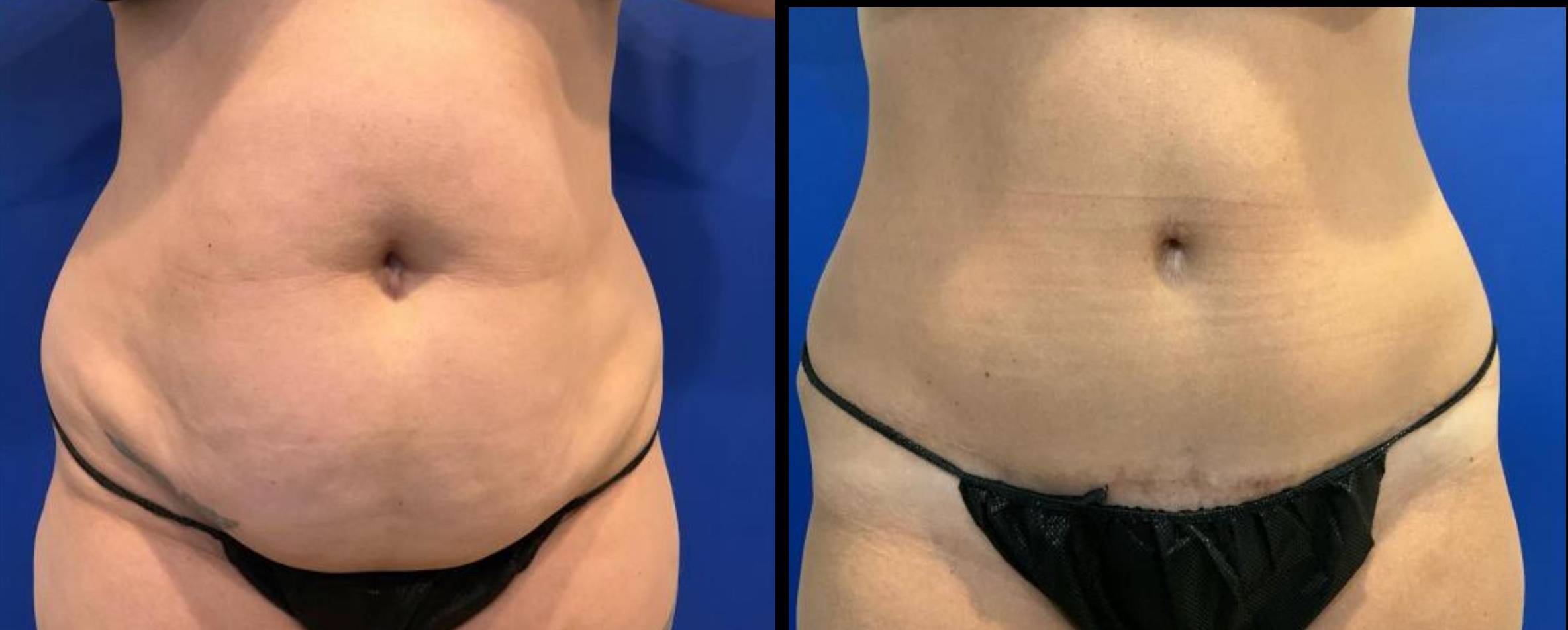 Tummy Tuck 11 