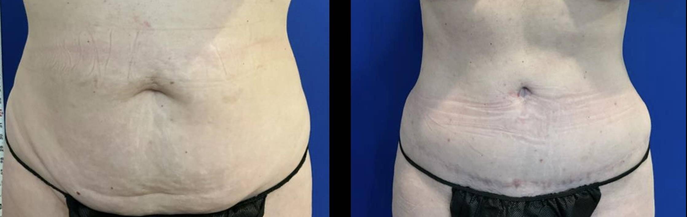 Tummy Tuck 