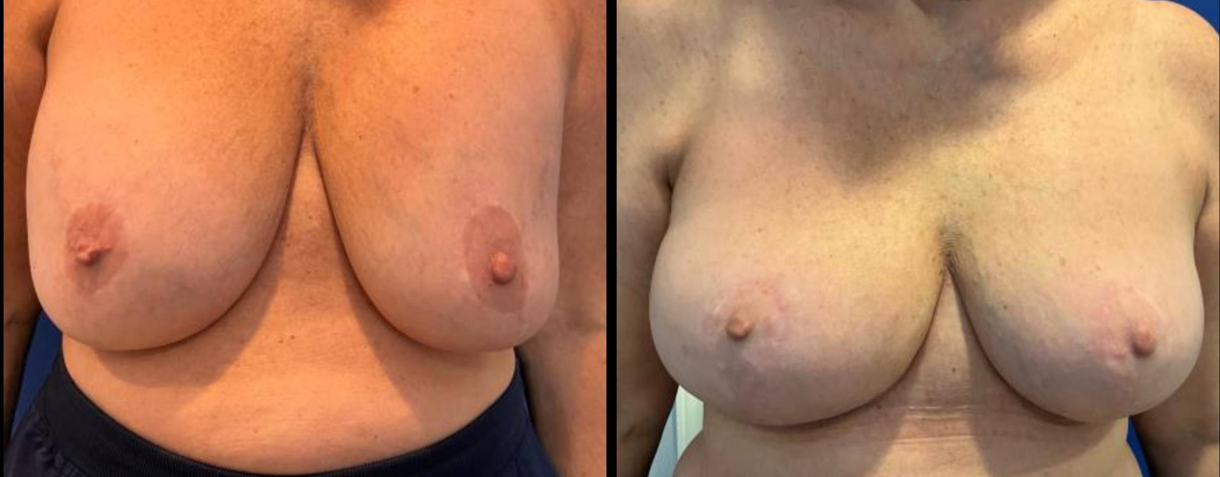 Breast Implant Removal with Mastopexy 12 