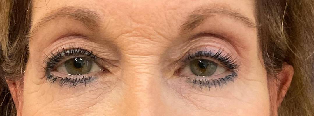 Upper lid Blepharoplasty Before
