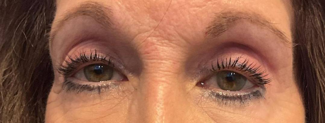 Upper lid Blepharoplasty After