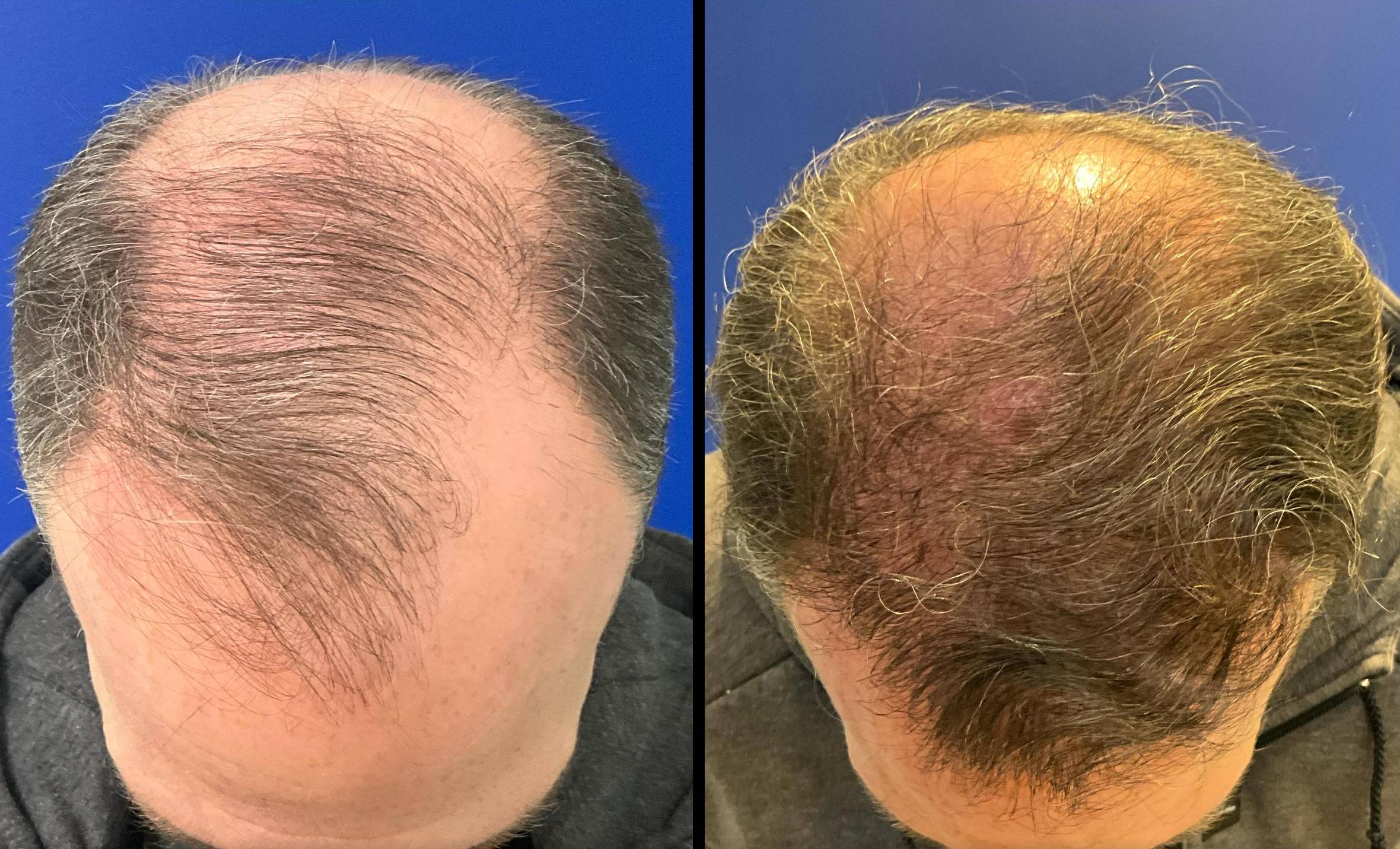 Hair Transplant 4 