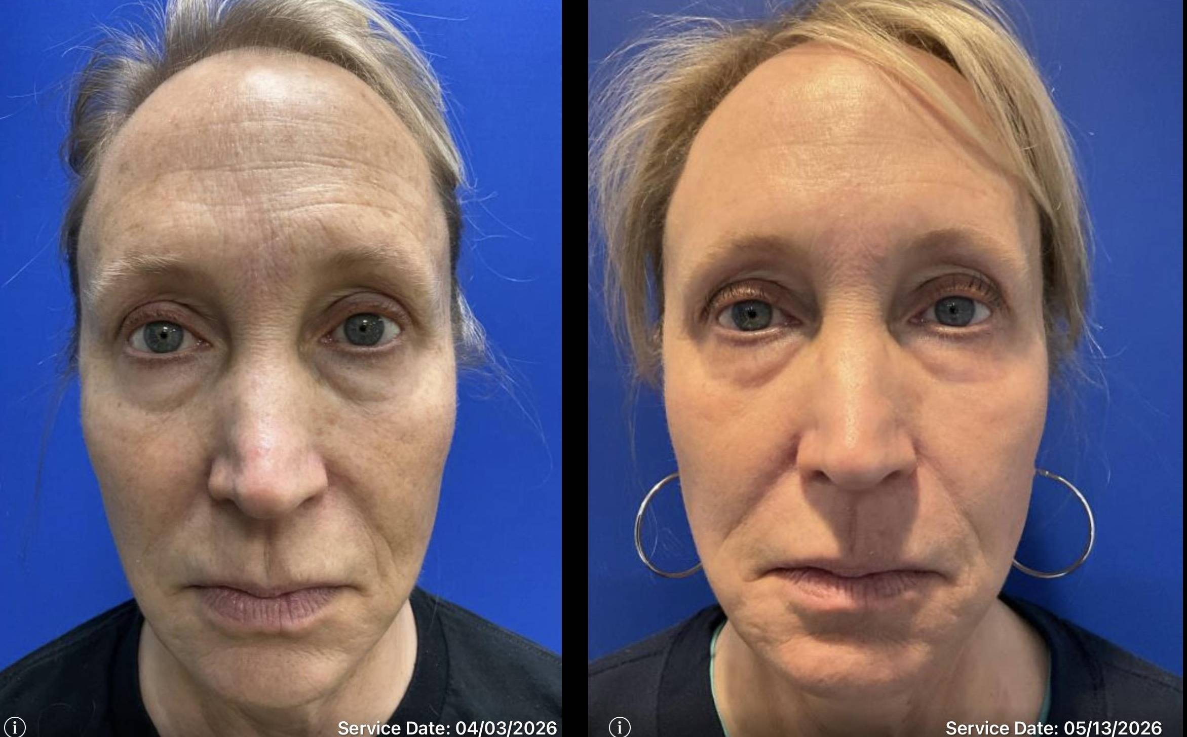 Laser Skin Resurfacing 