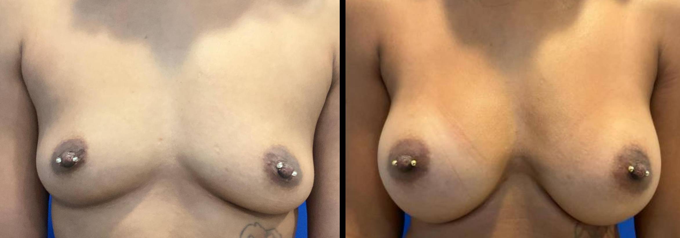 Breast Augmentation 16 