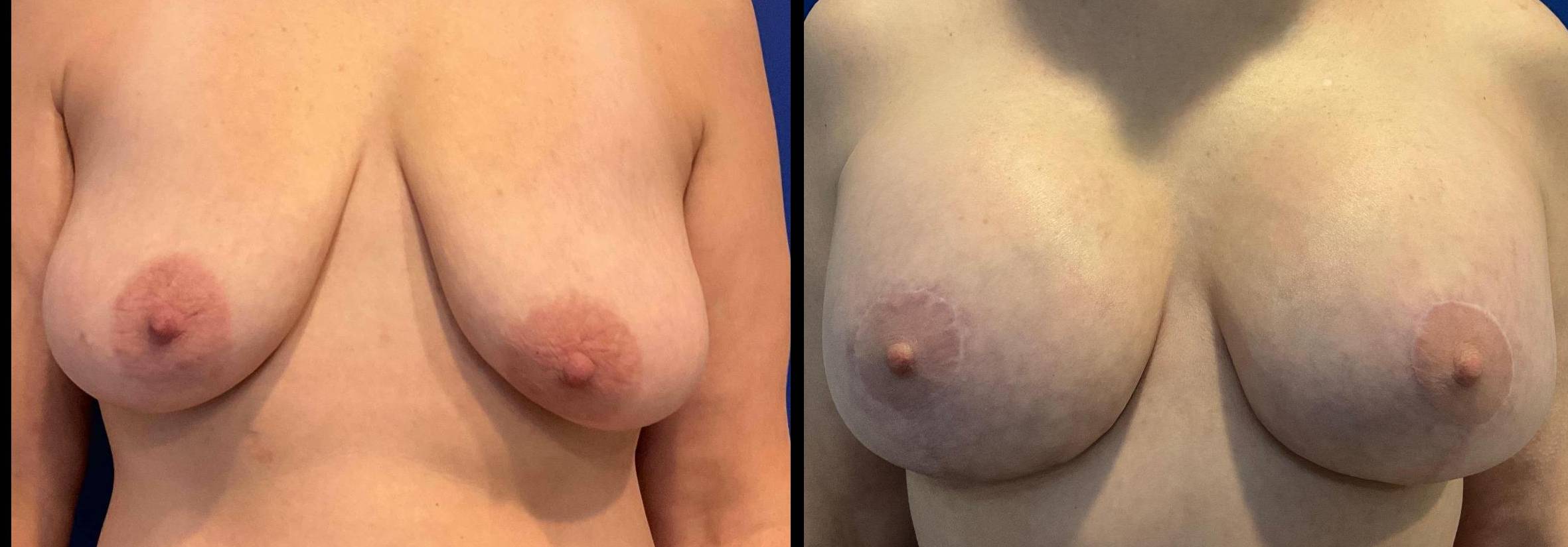 Breast Lift with Augmentation 17 