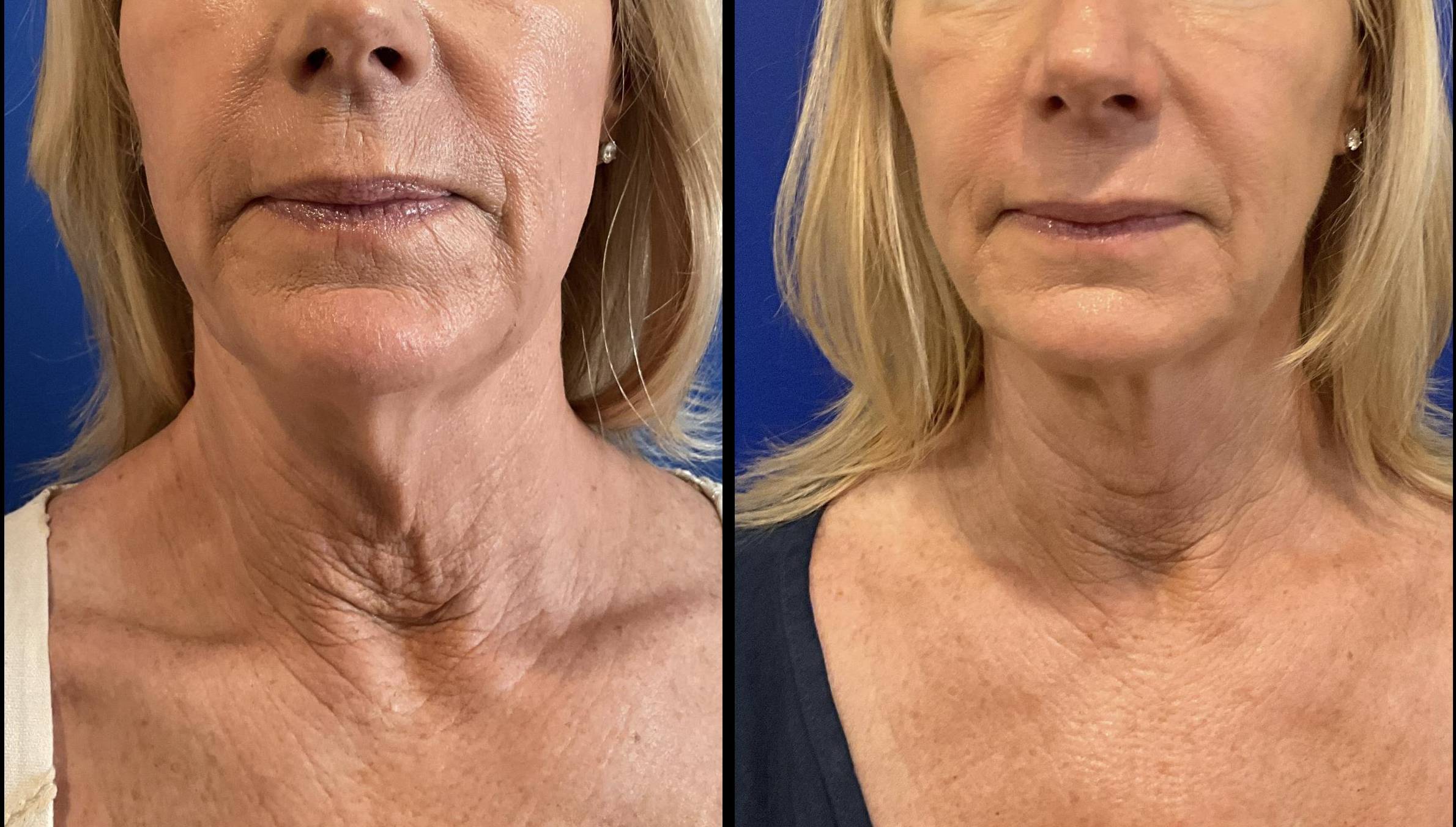 LSR Avava laser skin resurfacing LSR Avava laser skin resurfacing