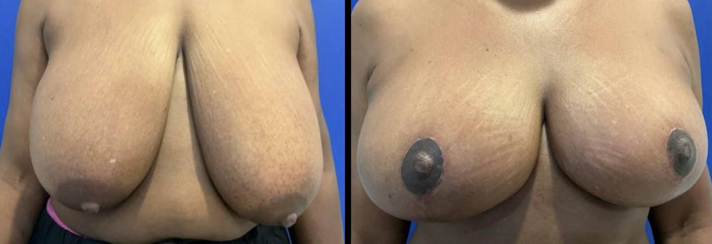 Breast Reduction Case 15 
