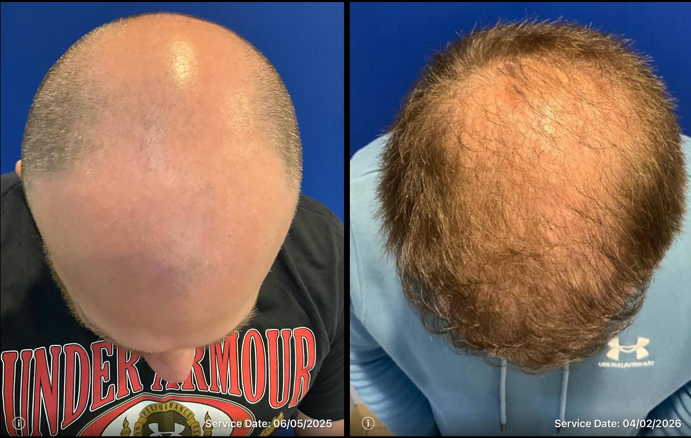 Hair Transpant Hair Transpant