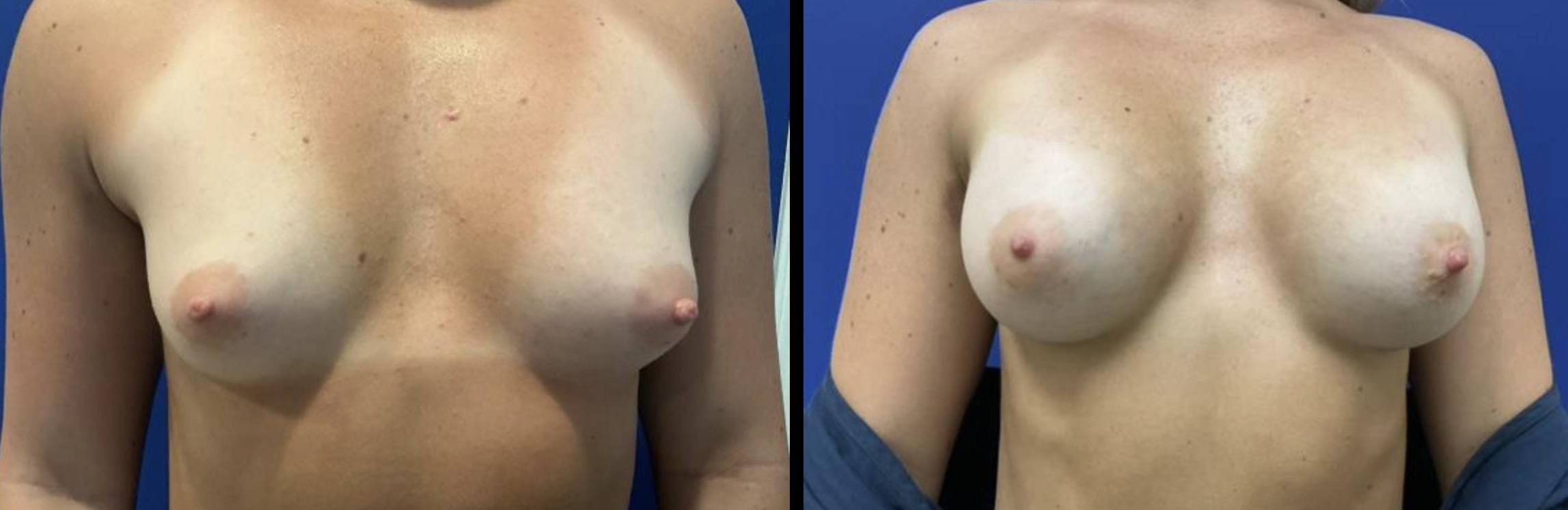 Breast Augmentation 18 