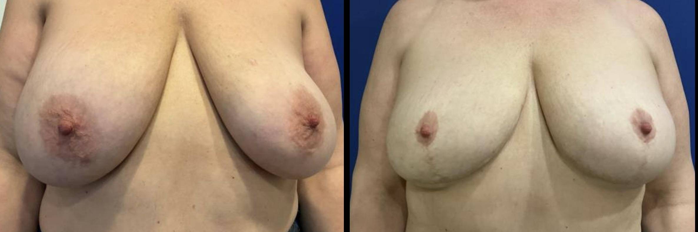 Breast Implant Removal w Lift 