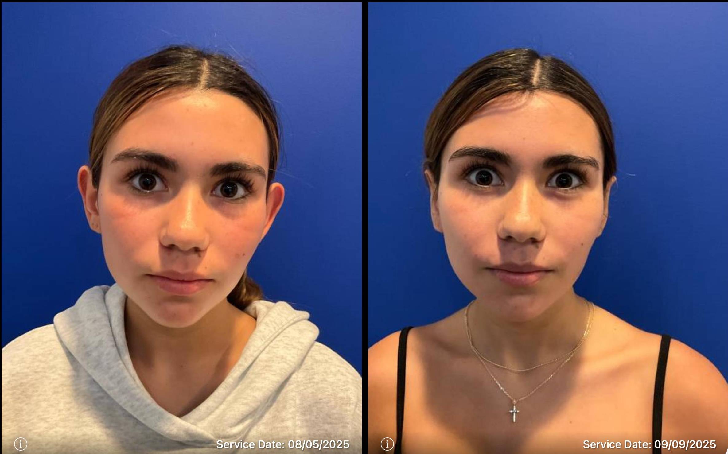 Otoplasty 