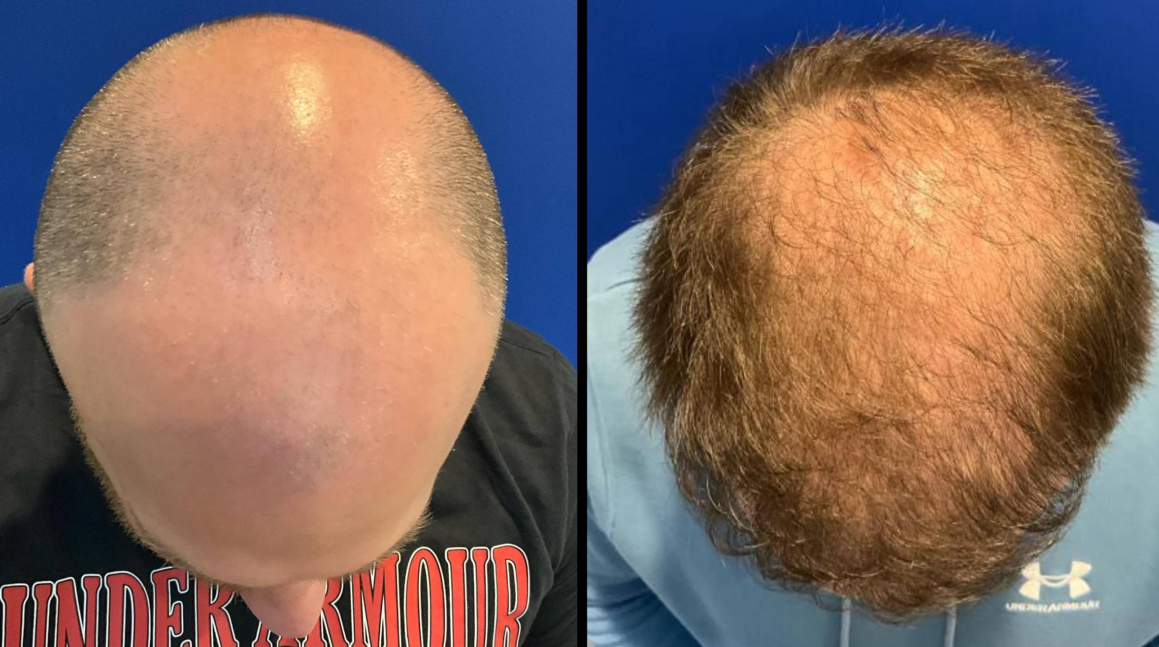 Hair Transpant 