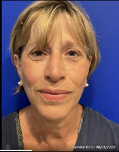 Facelift Before and After Pictures Bucks County, PA and Hunterdon County, NJ