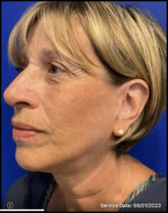 Facelift Before and After Pictures Bucks County, PA and Hunterdon County, NJ