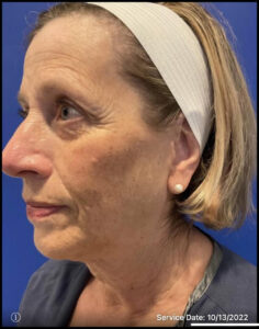 Facelift Before and After Pictures Bucks County, PA and Hunterdon County, NJ