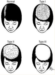 Hair Loss in Women in Bucks County, PA, and Hunterdon County, NJ