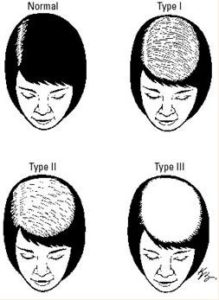 1-219x300 Hair Loss in Women