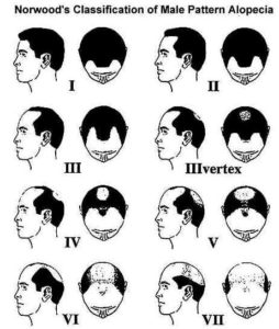 2-254x300 Male Pattern Baldness