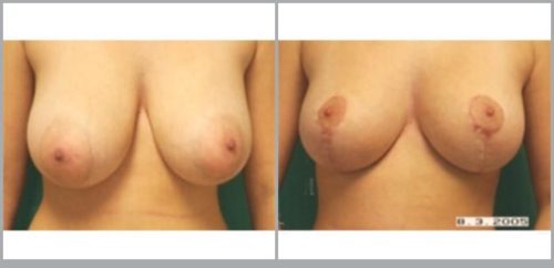 Breast Reduction Before and After Pictures Bucks County, PA, and Hunterdon County, NJ