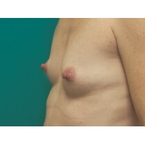 Breast Augmentation Before and After Pictures Bucks County, PA and Hunterdon County, NJ