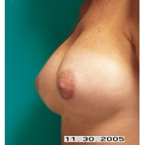 Breast Augmentation Before and After Pictures Bucks County, PA and Hunterdon County, NJ