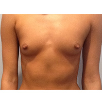 Breast Augmentation Before and After Pictures Bucks County, PA and Hunterdon County, NJ