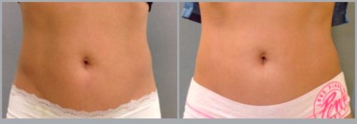 Coolsculpting Before and After Pictures Bucks County, PA, and Hunterdon County, NJ