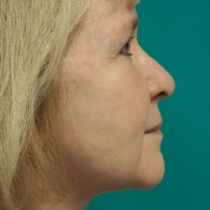 Facelift Before and After Pictures Bucks County, PA and Hunterdon County, NJ