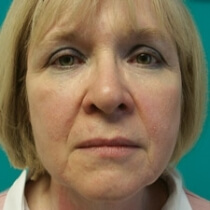 Facelift Before and After Pictures Bucks County, PA and Hunterdon County, NJ