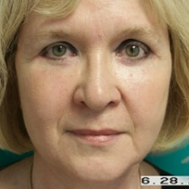 Facelift Before and After Pictures Bucks County, PA, and Hunterdon County, NJ
