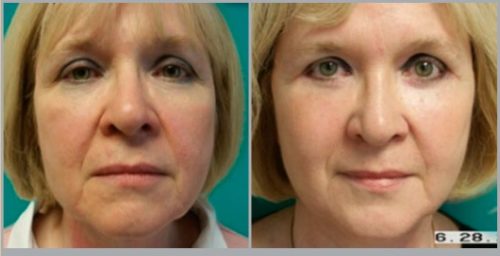 Facelift Before and After Pictures Bucks County, PA, and Hunterdon County, NJ