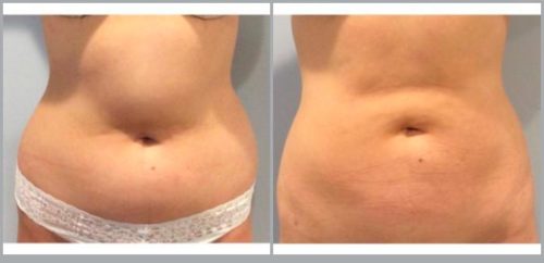 Liposuction Before and After Pictures Bucks County, PA, and Hunterdon County, NJ